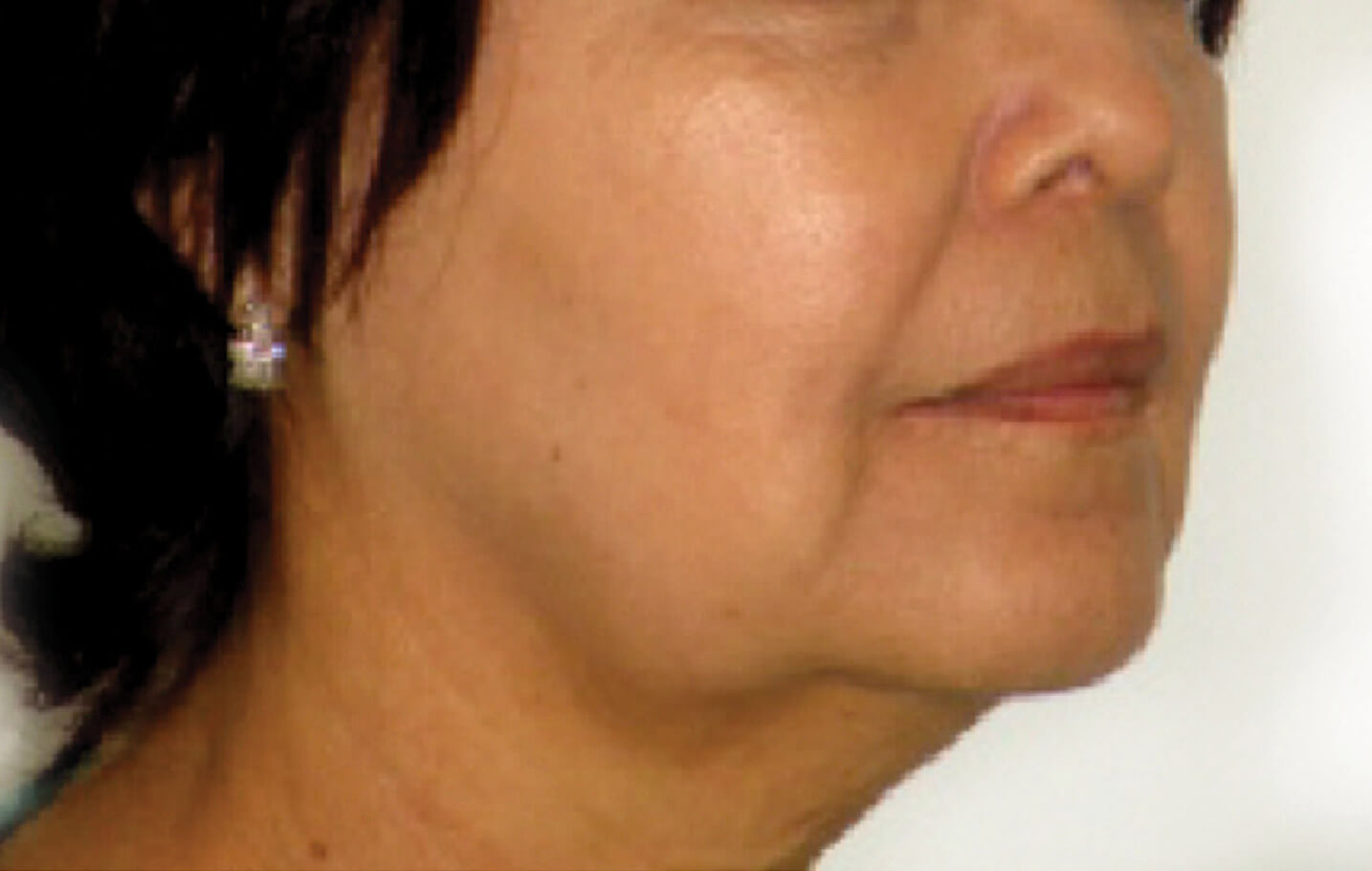 dermapure avant venus freeze 7