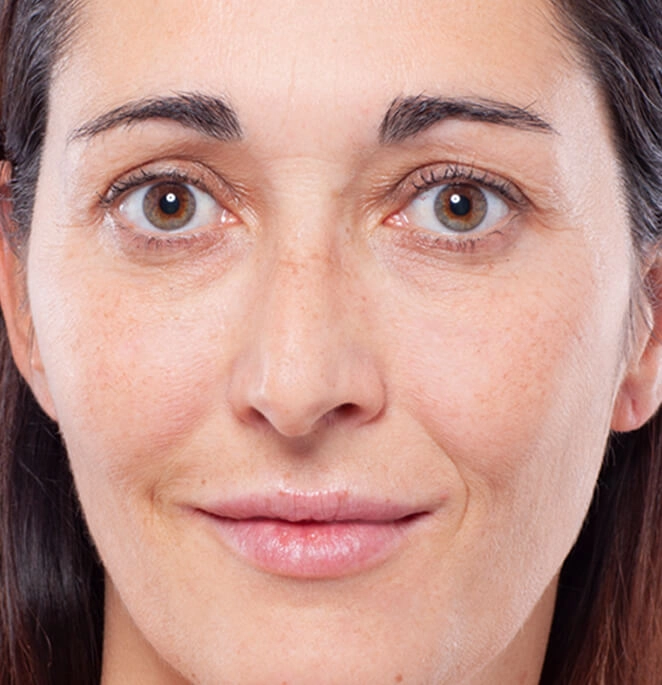 Injections volumisantes pour soigner les cernes et les lèvres - après