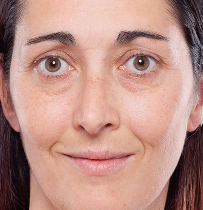 Injections volumisantes pour soigner les cernes et les lèvres - avant