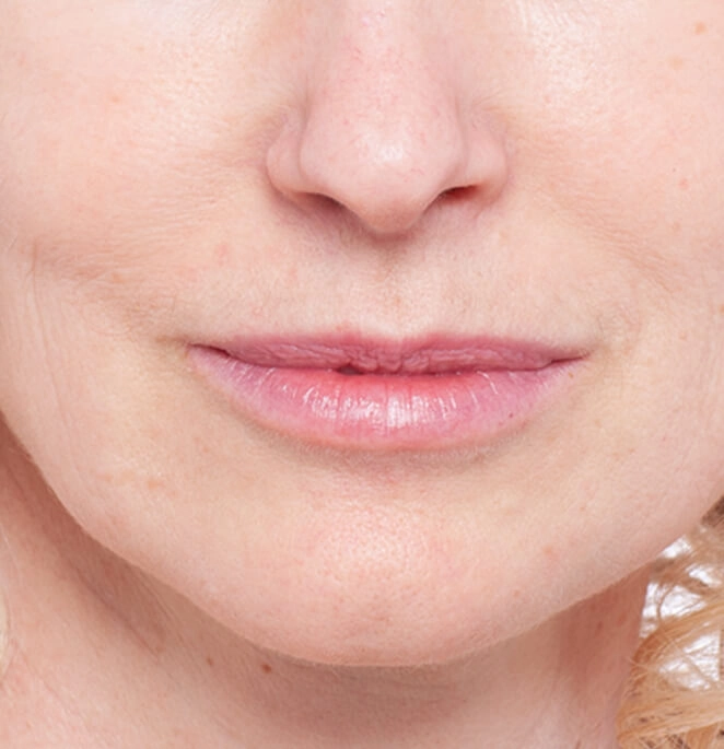 Injections volumisantes dans les lèvres : après