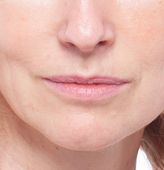 Injections volumisantes dans les lèvres : avant