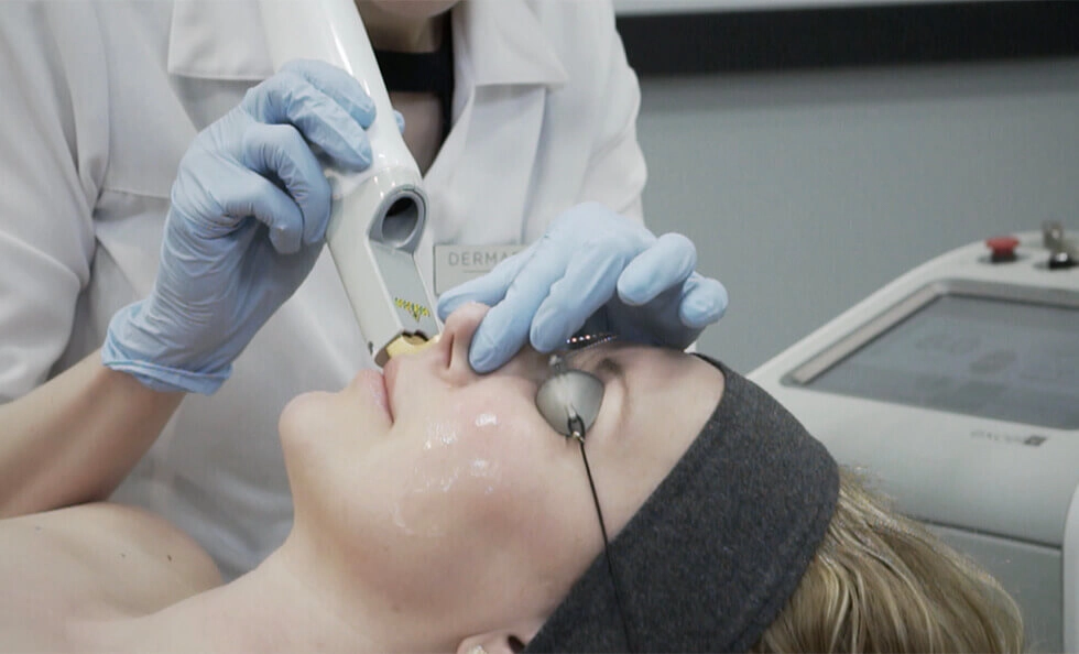 lasers vasculaires