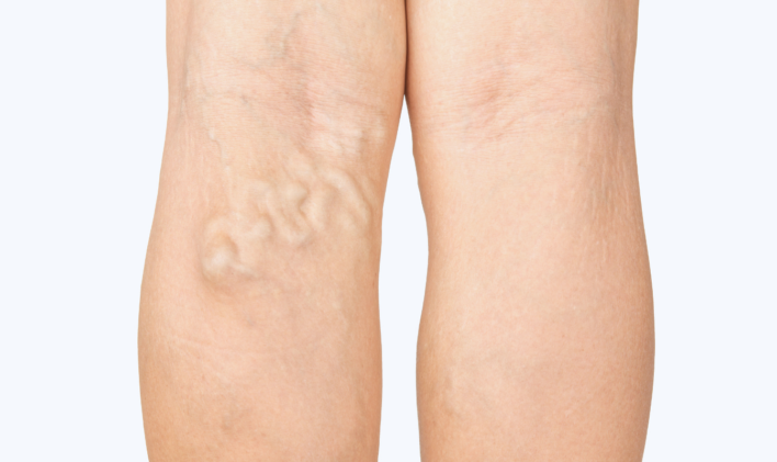 leg-vein