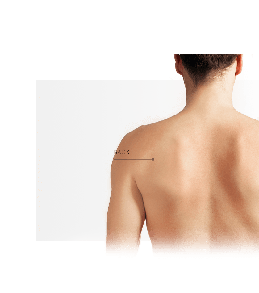 Photorejuvenation men back