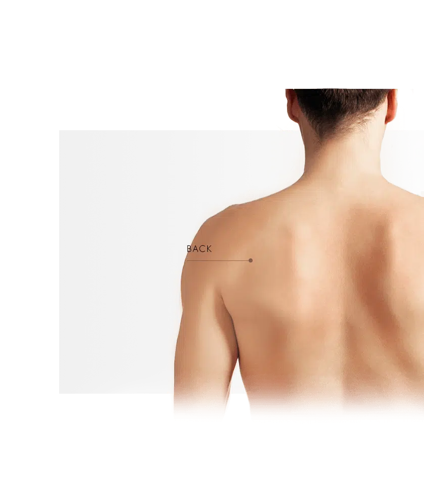 Photorejuvenation men back