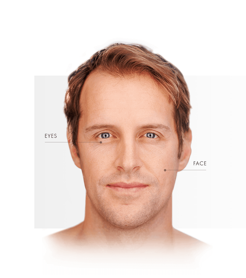 Thermage treated areas men