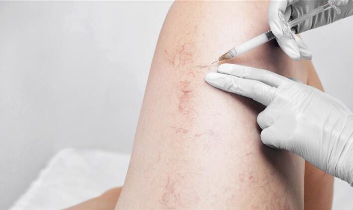 variscose_vein_injections