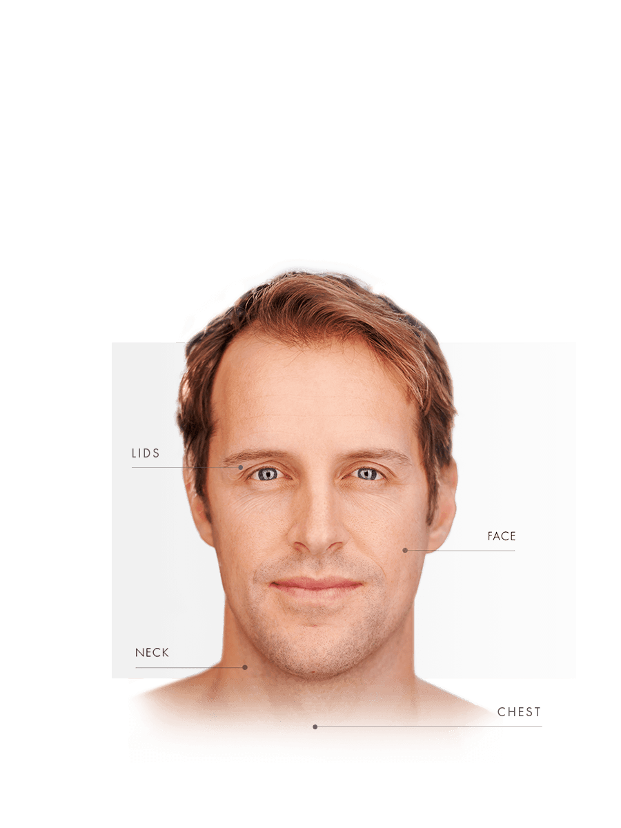 Microneedling for men for lids, face, neck and chest