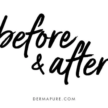 Before and after with Dermapure