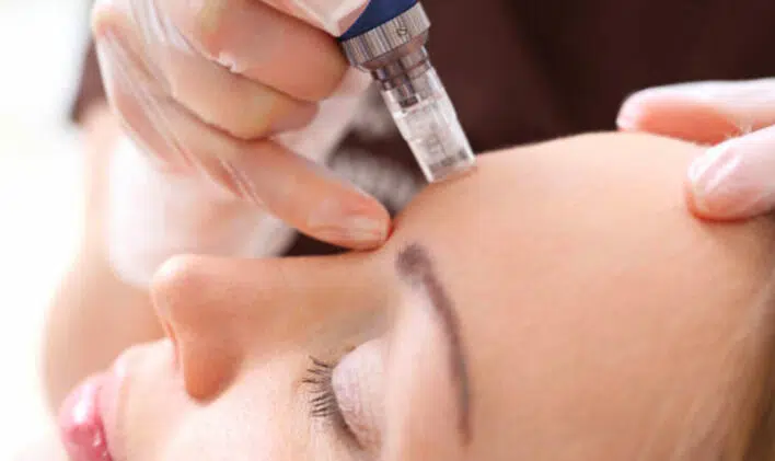 Traitement de microneedling