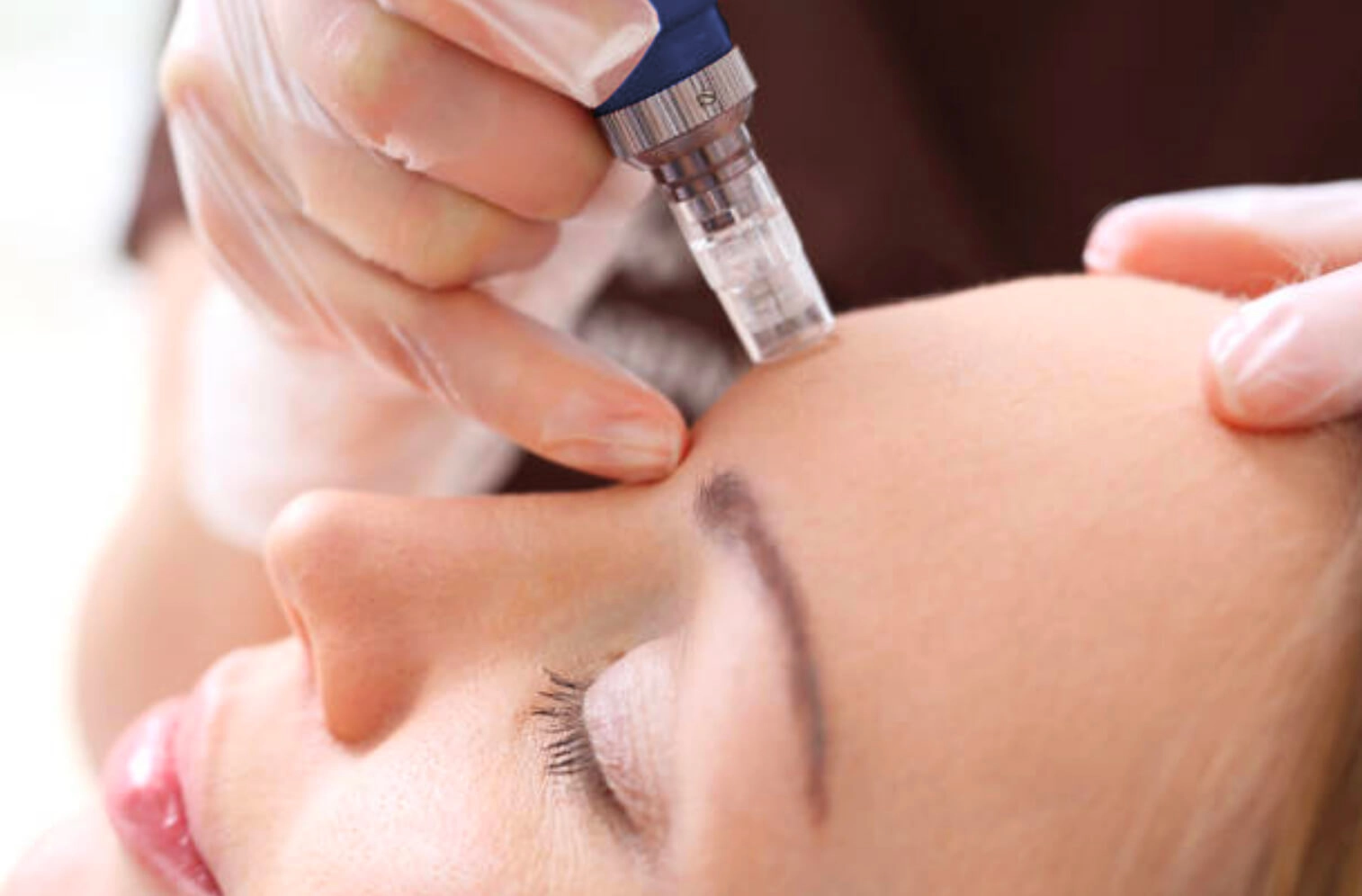 Traitement de microneedling