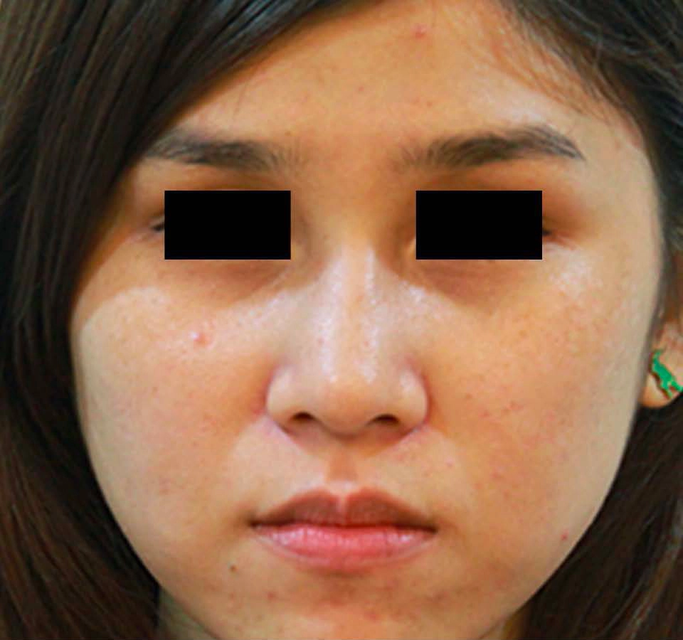 Laser PicoSure
