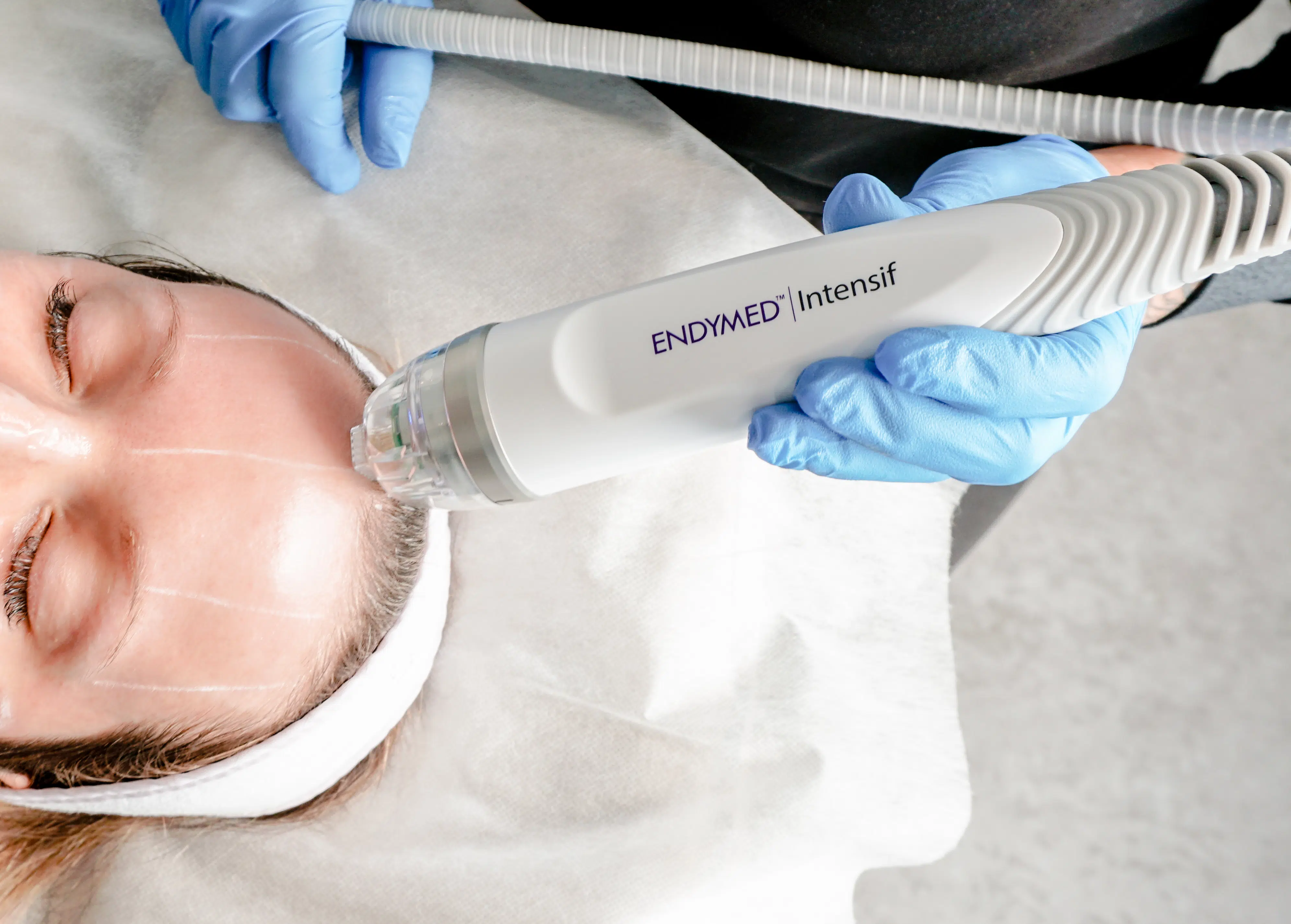 Microneedling in Sherbrooke
