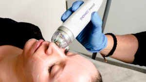 RF Microneedling