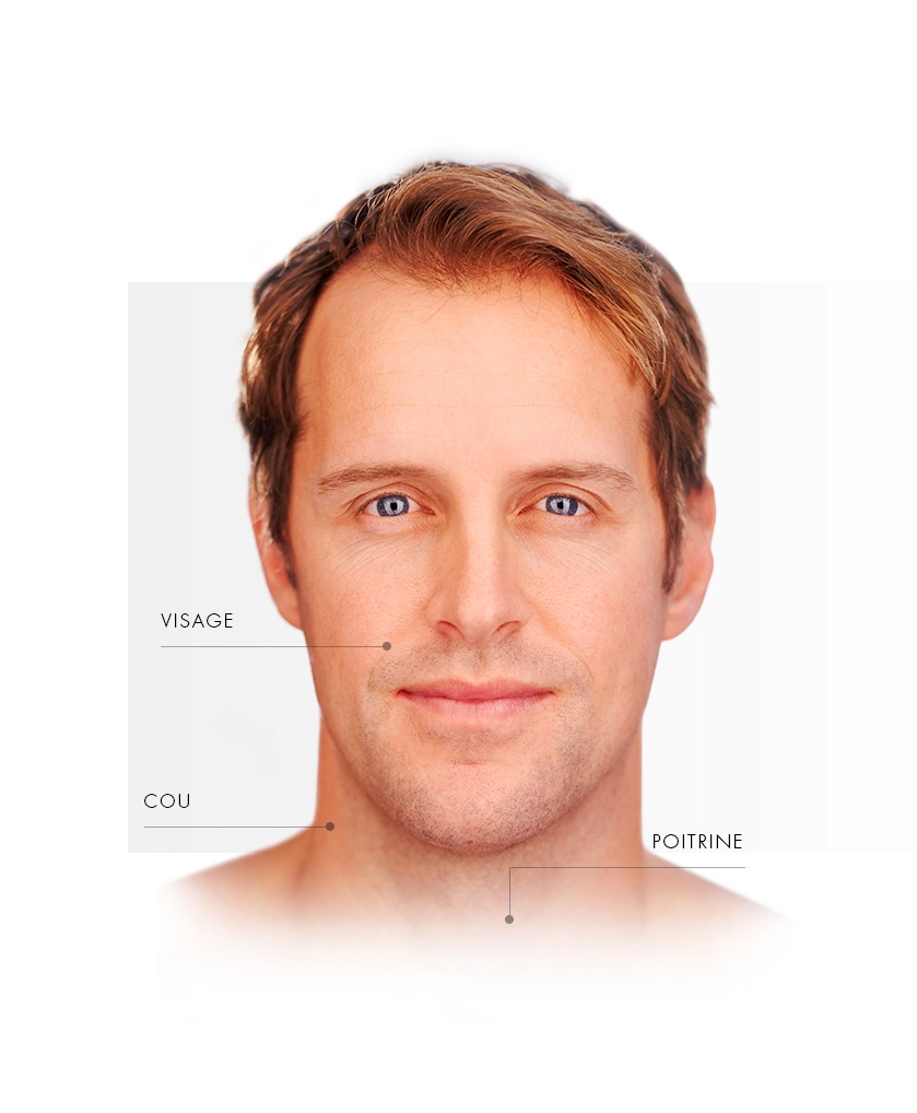 microlaserpeel_homme_face_FR