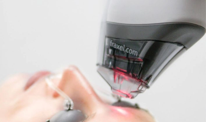 Fractional lasers price in Vancouver