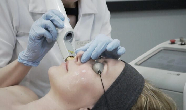 Vascular lasers treatment in Vancouver