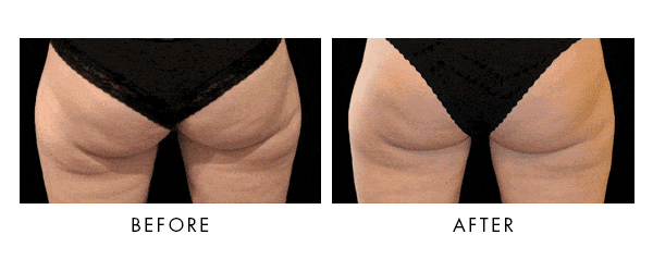 CoolSculpting Before-after results