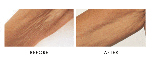 Venus Freeze Before-after results