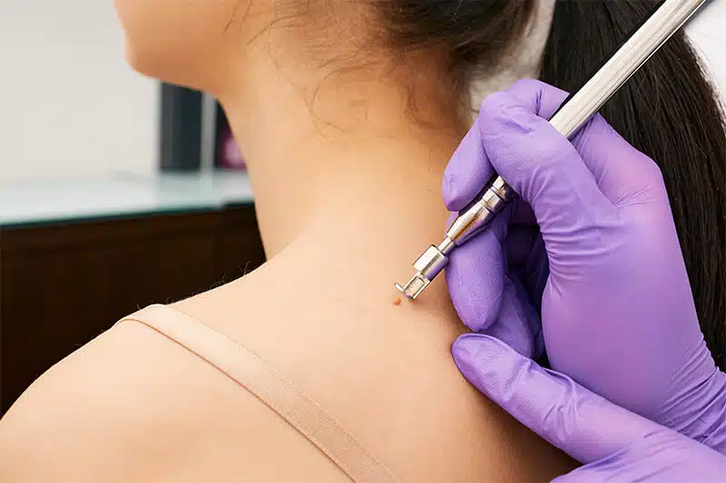 Mole Removal