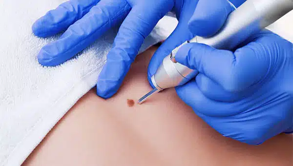 Mole Removal