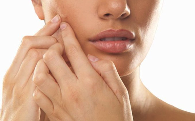 Getting rid of acne