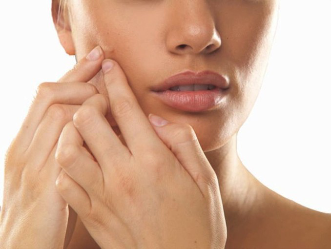Getting rid of acne