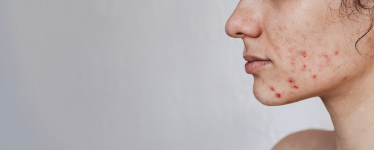 Acne Scars