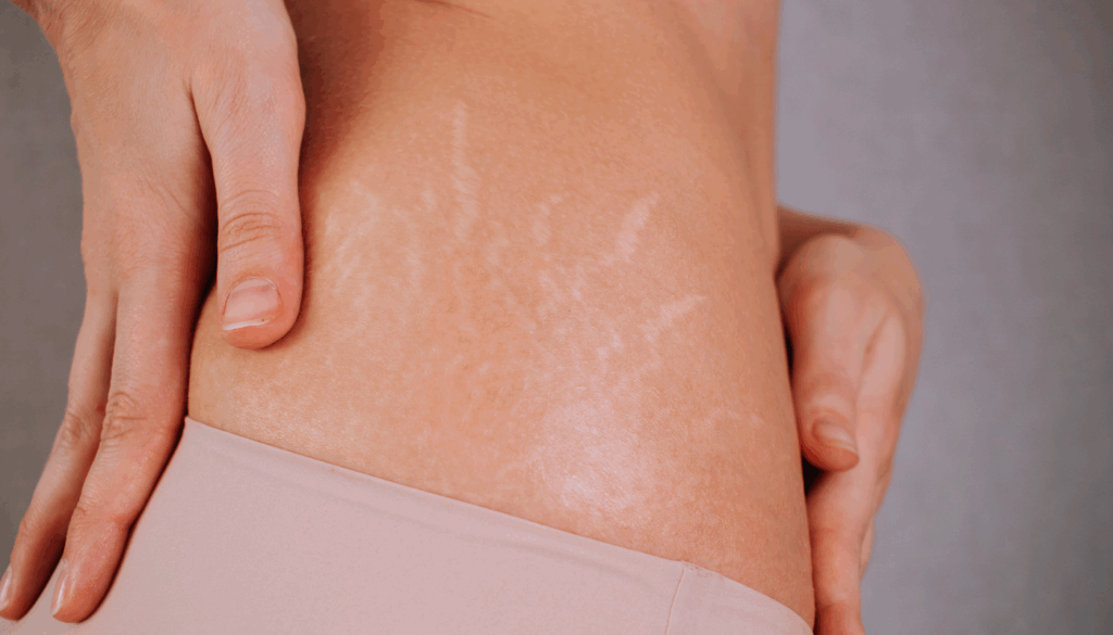 Stretch Marks After Weight Loss