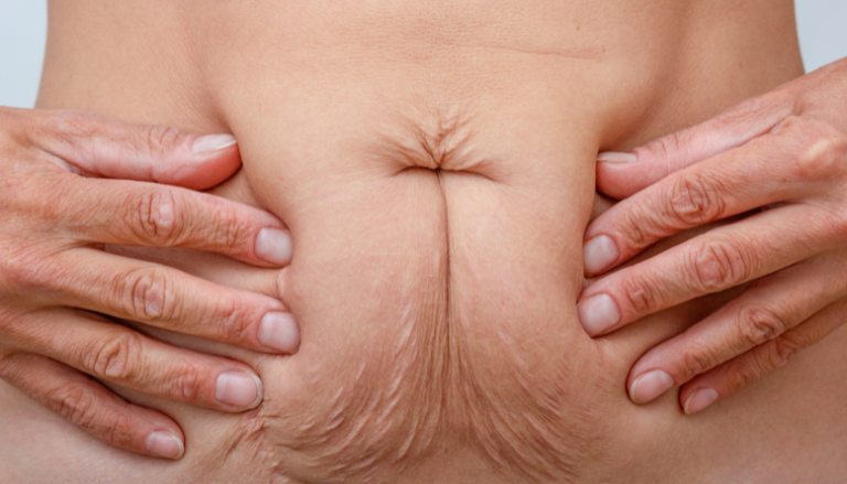 Belly Skin After Pregnancy