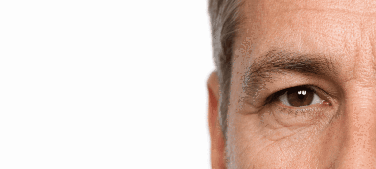 Hooded-eyes-condition
